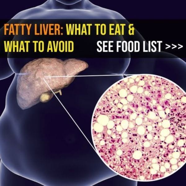 Diet Tips for Fatty Liver Disease